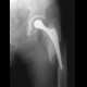 Periprosthetic fracture of the left femur: X-ray - Plain radiograph